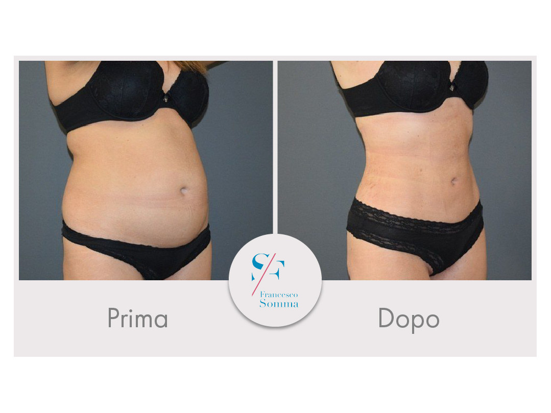 Vaser Lipo Prima E Dopo Prima e dopo un intervento di liposuzione- Dott. Somma Napoli