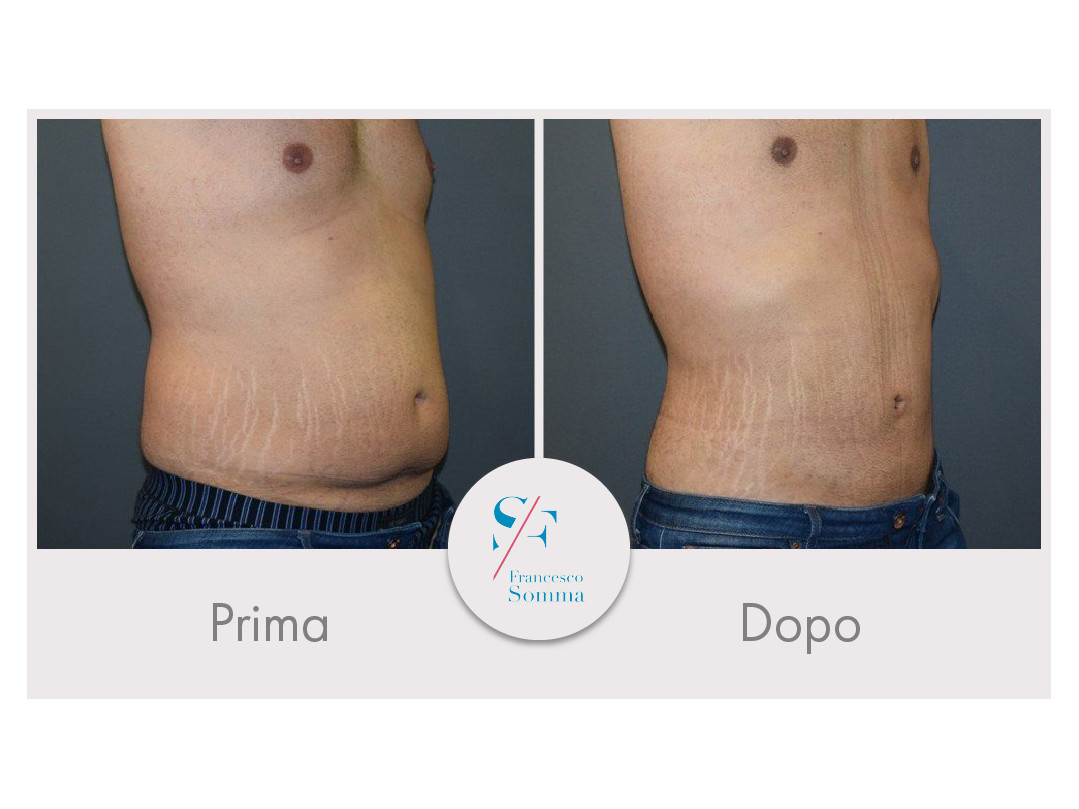 Vaser Lipo Prima E Dopo Prima e dopo un intervento di liposuzione- Dott. Somma Napoli