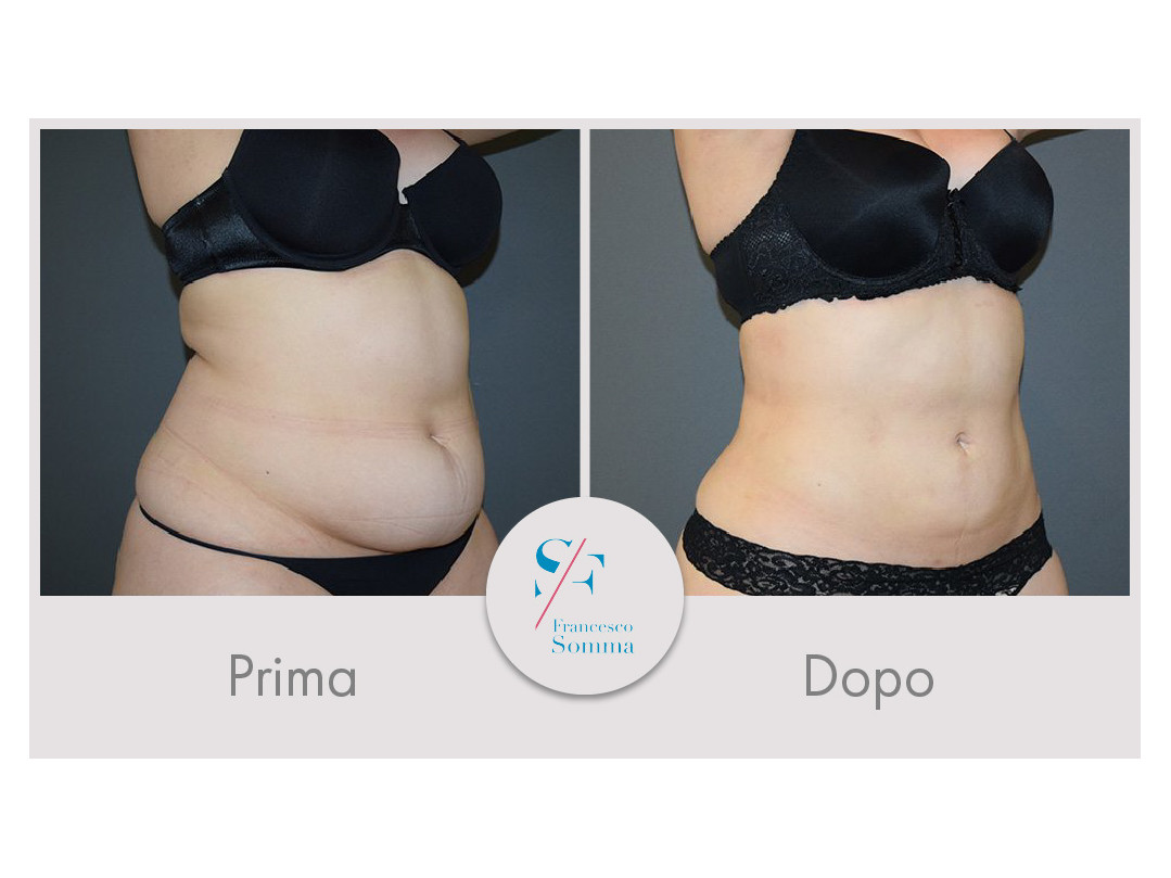 Vaser Lipo Prima E Dopo Prima e dopo un intervento di liposuzione- Dott. Somma Napoli